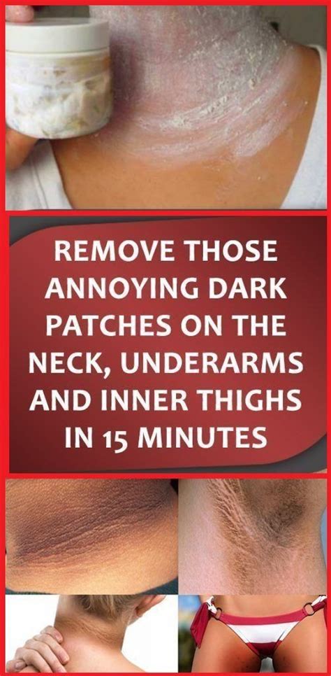 Remove Those Annoying Dark Patches On The Neck Underarms And Inner