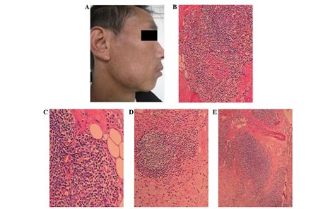 Kimura S Disease Kimura Sykdom Auricular Infra Parotis Glandula Behra