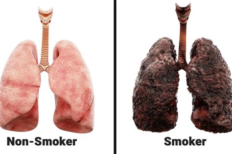 In adjusted analyses, smoking cessation was strongly associated with the amount of abnormality observed in the previous year's screening (p <.0001). How smoking impacts lungs | Dr. Ajay Kumar Lal Das | Paras ...