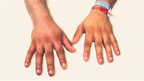 A blood clot is simply blood cells that have massed together in an area. Blood Chunks In Stool - Stools Item