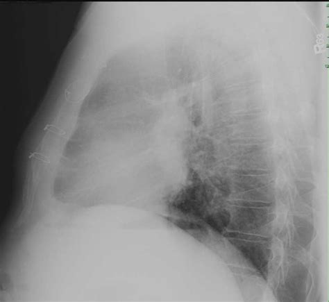 Hilar Adenopathy On Chest X Ray X Rays Case Studies Ctisus Ct Scanning