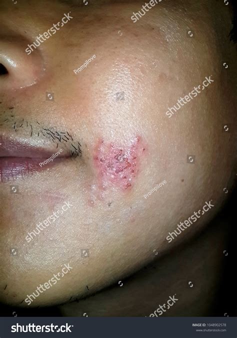 Skin Infected Herpes Zoster Shingles Virus Stock Photo 1048902578