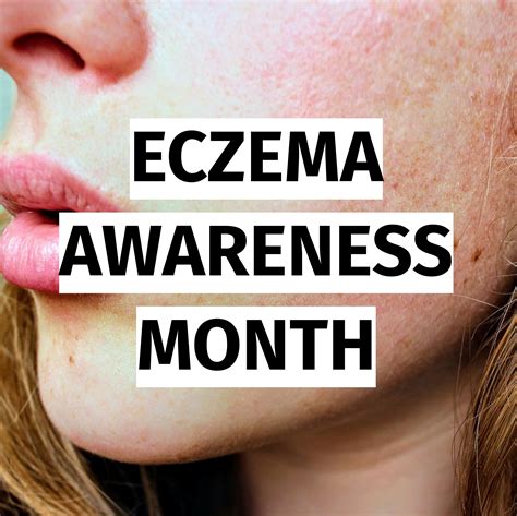 October Is Eczema Awareness Month In 2022 Awareness Month Awareness