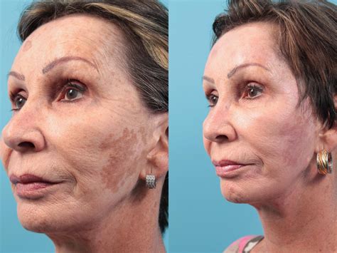 Halo Laser Skin Resurfacing West Des Moines And Ames Koch And Carlisle