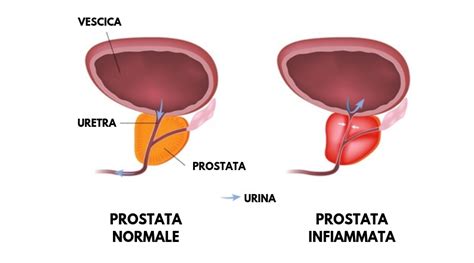 Prostatite E Ipertrofia Prostatica Benigna