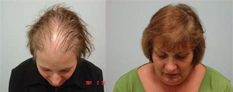I'm a hair loss expert. Hair Restoration Surgery performed in Connecticut (CT) and ...