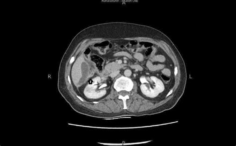 Ct Scan Abdomen With Iv Contrast Cross Sectional View Showing A Small