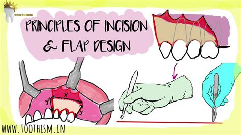 Principles Of Incision Making And Flap Design Basic Principles Of