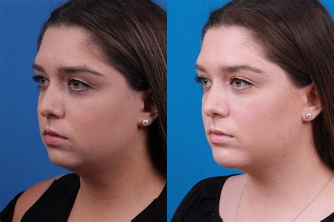 Patient 122593748 Laser Assisted Weekend Neck Lift Before And After