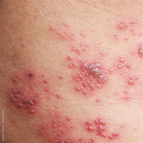 Identifying 21 Common Red Spots On Skin Universal Dermatology Tyello Com