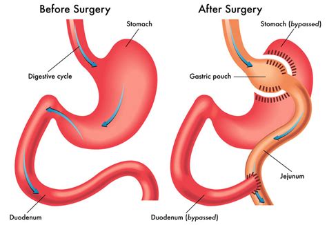 Gastrik Bypass Mide Bypass Ameliyatı Nasıl Yapılmaktadır