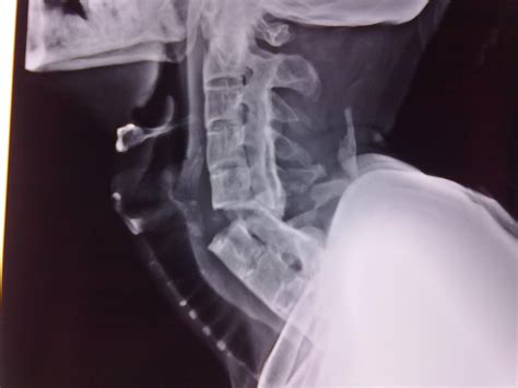 Pin On Spinal Fracture