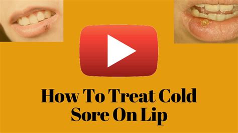 How To Get Rid Of A Cold Sores Fast Youtube