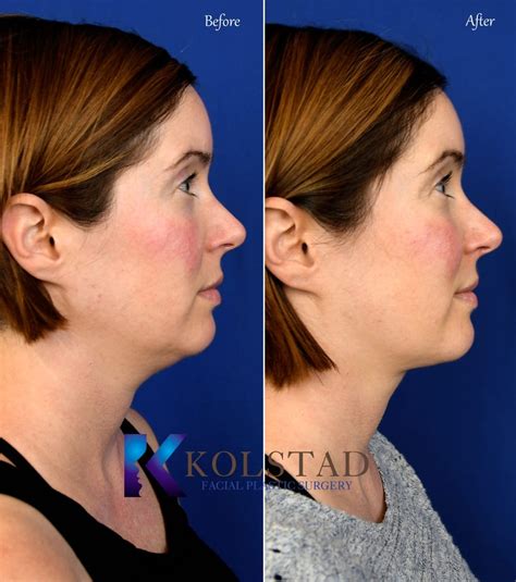 Chin And Neck Liposuction Before And After Gallery Dr Kolstad San