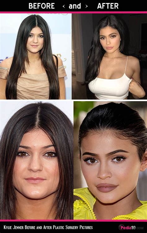 Kylie kristen jenner (born august 10, 1997) is an american media personality, socialite, model, and businesswoman. Kylie Jenner Before and After Plastic Surgery Pictures ...