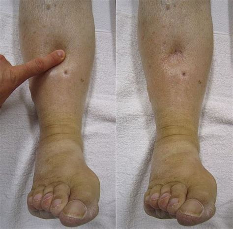 Bilateral Leg Swelling Wikem