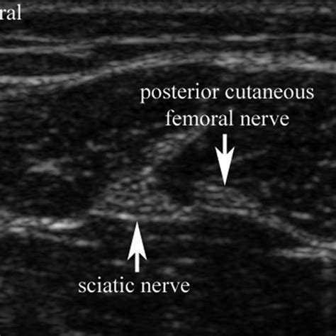 Transverse View Of The Sciatic Nerve And The Posterior Cutaneous