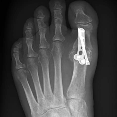 Hallux Limitus Arthritis Of The Big Toe Thames Foot Clinic