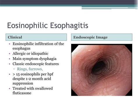 Ppt Internal Medicine Board Review 2010 Gastroenterology Powerpoint