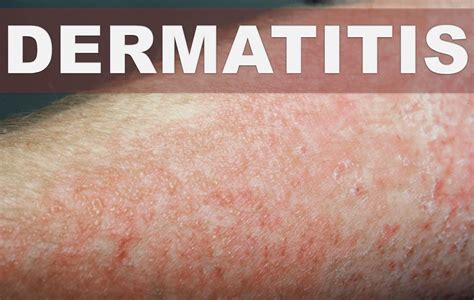 Remedios Caseros Para La Dermatitis Como Curar La Inflamación E