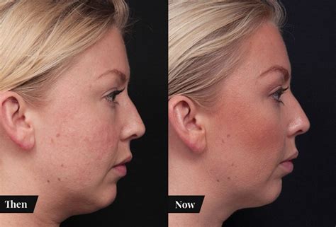 3 Ways To Reshape Your Jawline And Chin Profile Beautycrew