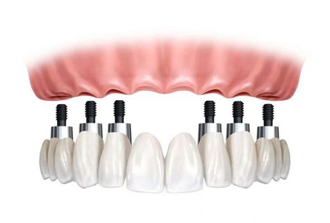 Tipos De Implantes Dentales 2023