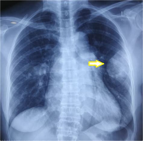 Preoperative Chest X Ray Of Patient Notice A Round Mass Pointed By