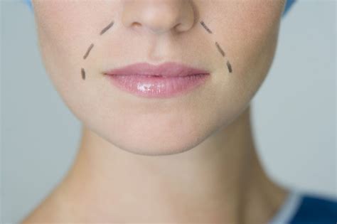 Sposoby Likwidacji Bruzd Nosowo Wargowych Blog Chirurgicznie Precyzyjny