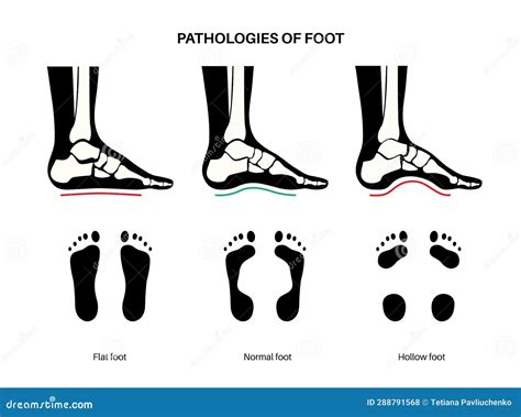 Foot Pathologies Poster Stock Illustration Illustration Of Barefoot