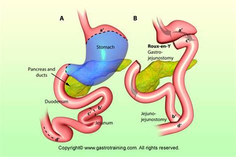 Gastroenterology Education And Cpd For Trainees And Specialists Roux En Y Gastric Bypass
