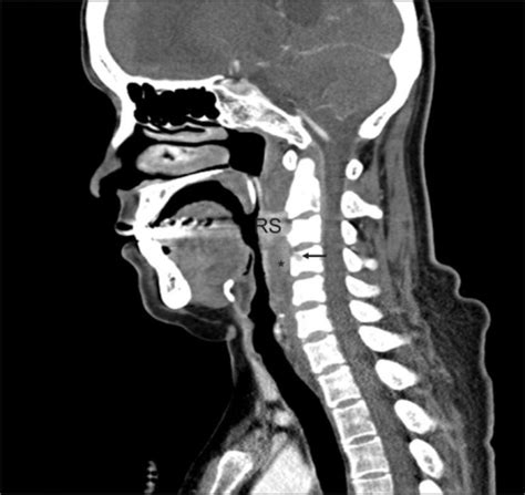 A Ct Of The Neck With Contras Extensive Edema Of The R Open I