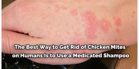How To Get Rid Of Chicken Mites In Your House 10 Effective Steps 2024