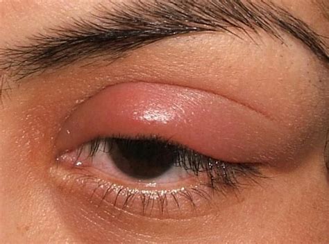 Upper Eyelid Infection