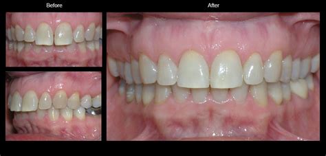 If you feel comfortable while eating, you have the option to remove invisalign. Invisalign Teeth Straightening No Braces | Tyler East Texas