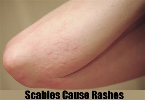 4 Most Common Scabies Symptoms Signs And Symptoms Of