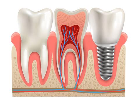 Will A Dental Implant Cause A Problem With Airport Security Artistry