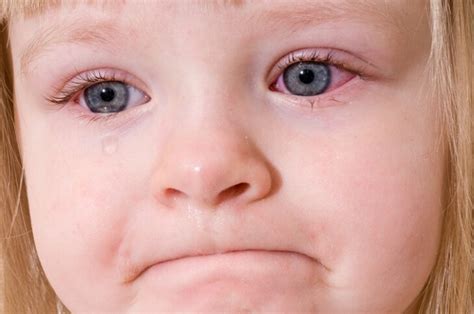 Pink eye is a common eye infection in children and adults. 17 Natural Home Remedies for Pink Eye
