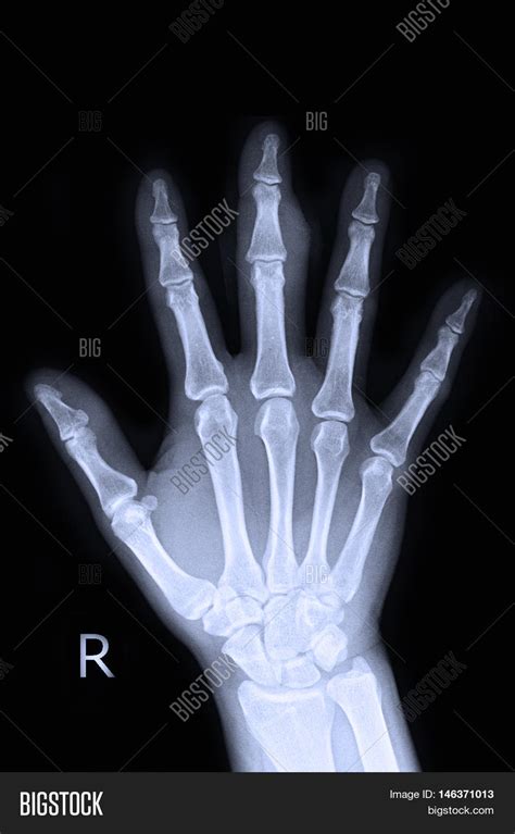The Gallery For Xray Right Hand