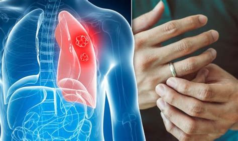 Lung Cancer Symptoms Signs Of A Tumour Include A Cough And Fingertip Changes Express Co Uk