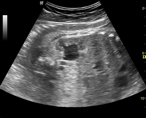 Ultrasound Imaging Sonography Of A Case Of Bilateral Fetal Hydronephrosis