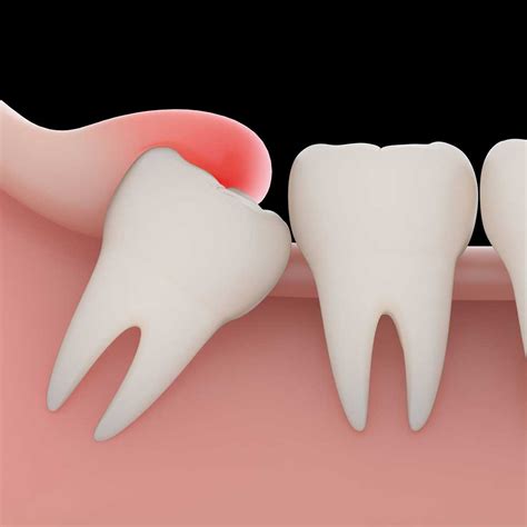 Wisdom Teeth Removal Cost South Africa 2018 Teeth Poster