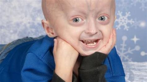 Experimental Drug Extends Survival In Progeria Dna Science