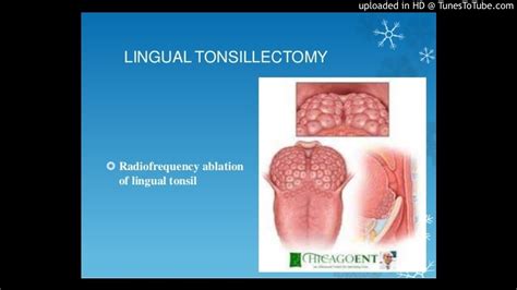 Lingual Tonsillectomy With Palatal Surgery For The Treatment Of