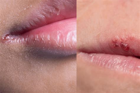 Angular Cheilitis Vs Cold Sore Angular Cheilitis Causes