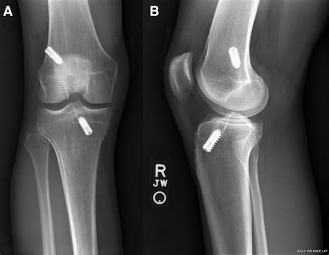 Generalized Hypermobility Knee Hyperextension And Outcomes After Anterior Cruciate Ligament