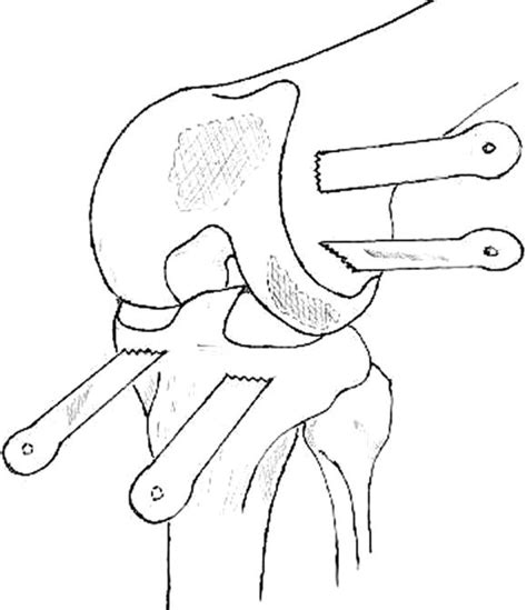 Minimally Invasive Selective Osteotomy Of The Knee Arthroscopy