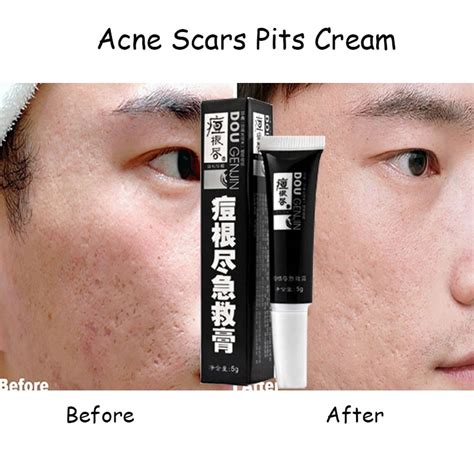 Acne Scars Pit Cream Lightening Anti Acne Cream To Remove Dark Spots