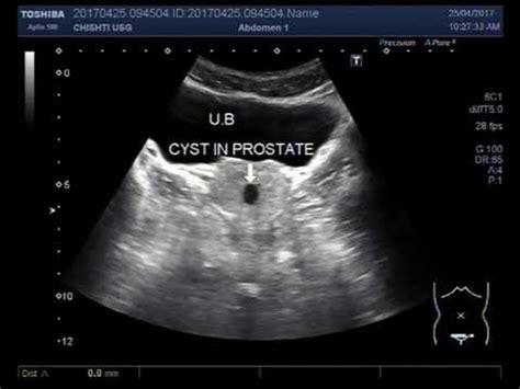 Prostate Cyst Ultrasound