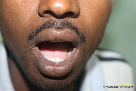 A Case Of Vitiligo On Lips Homeo Energy