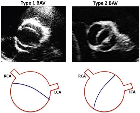 Micrornas Fingerprint Of Bicuspid Aortic Valve Journal Of Molecular And Cellular Cardiology